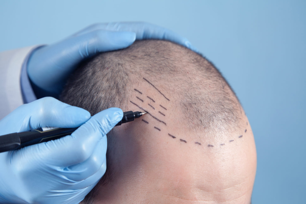 Hair Transplants: The Difference between FUE and FUT Procedures in Hair Restoration.