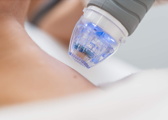 A Fire and Ice Approach to Fat Reduction & Skin Tightening in Coolsculpting, Vanquish.