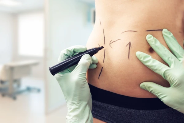 What Is Liposuction Surgery? in Liposuction.