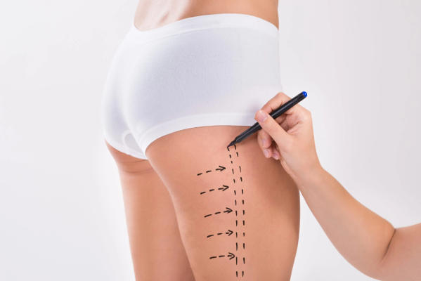 Navigating the Recovery Process After a Thigh Lift