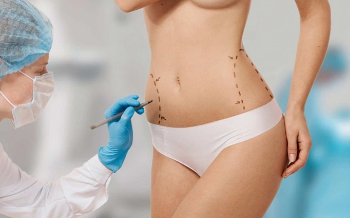 liposuction in New Jersey