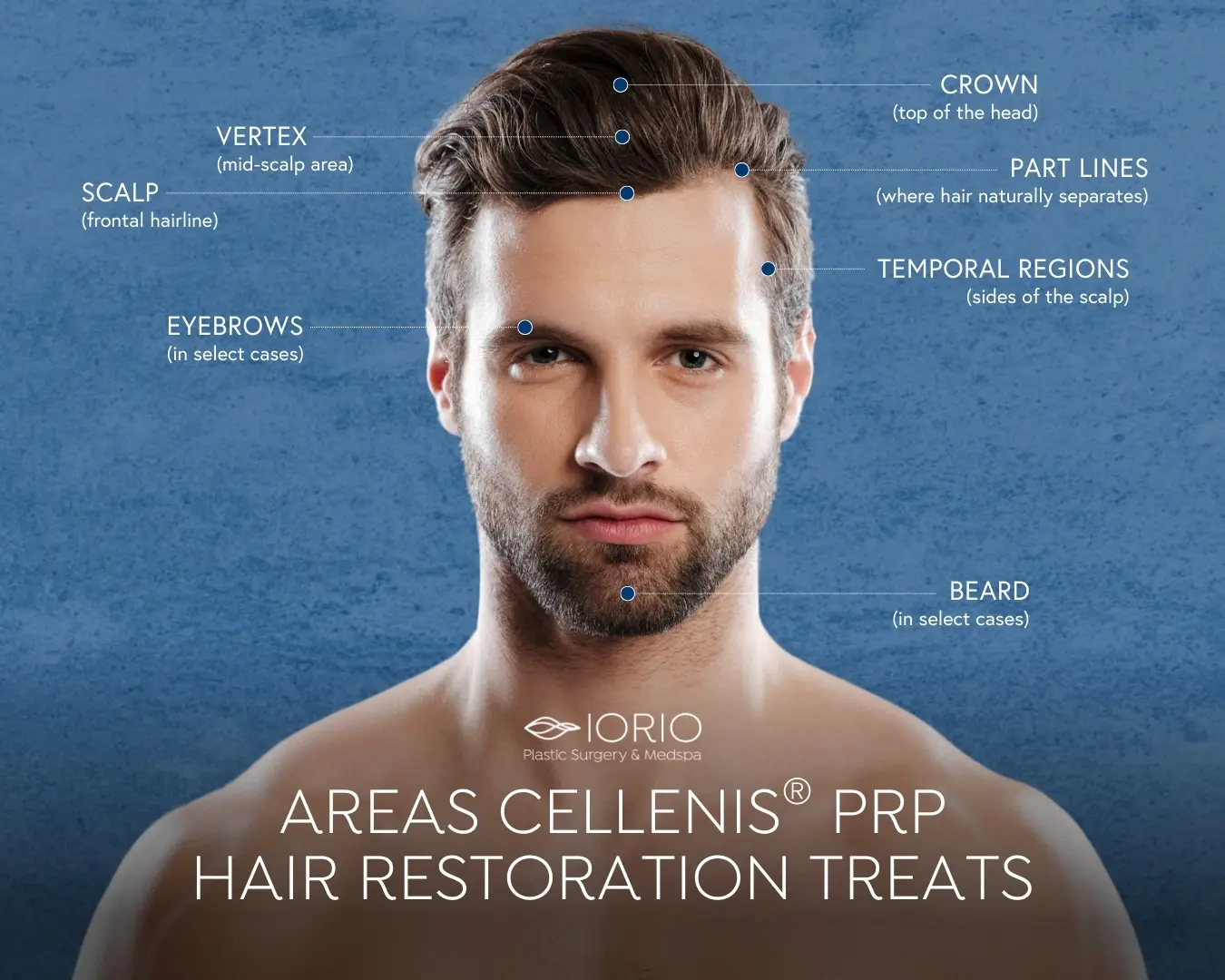 Cellenis PRP for Hair Restoration in NJ | Iorio Plastic Surgery